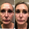 Dr. Herzog Before & Afters Brookwood Dermatology