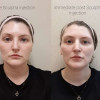 Dr. Herzog Before & Afters Brookwood Dermatology