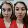Dr. Herzog Before & Afters Brookwood Dermatology